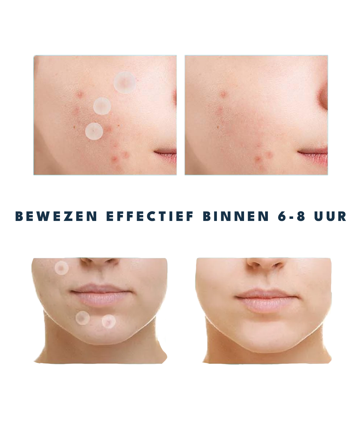 Pimple Patches - Onzuiverheden Stickers (108 Stuks)